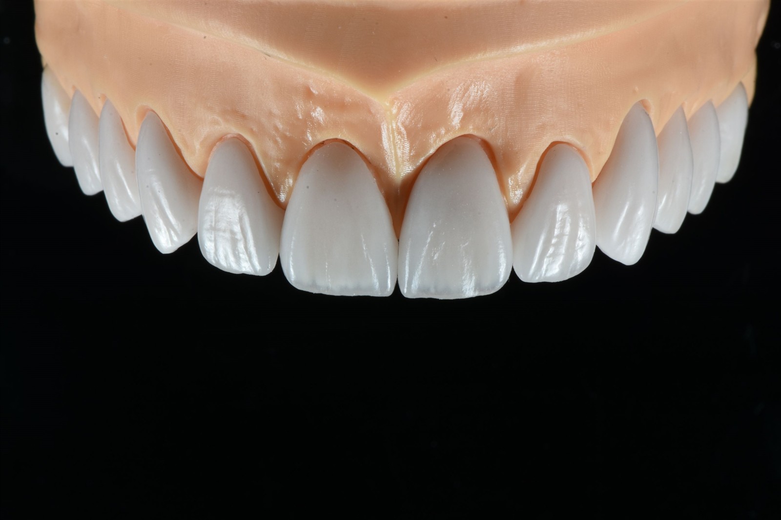 E-max veneers 71 E-max veneers 71