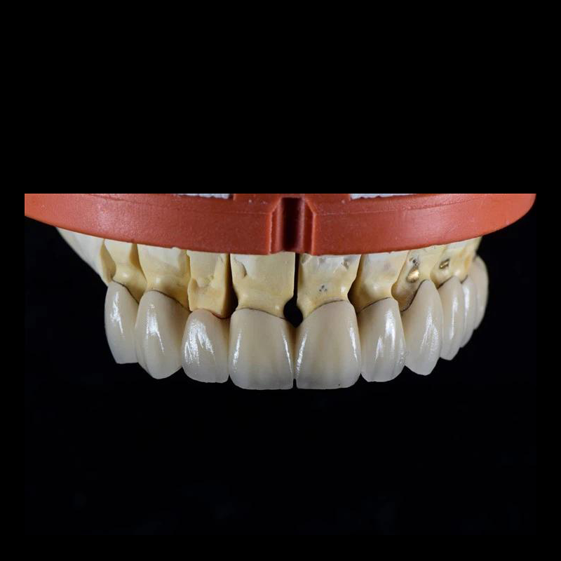 PFM Ceramic Crowns