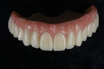 تاج موقت رزین اکریلیک