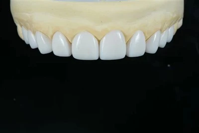 ونیرهای کامل-Contour E.max