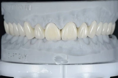 E-max Crown فشار داده شده است